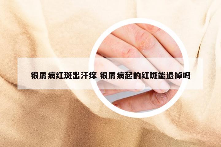 银屑病红斑出汗痒 银屑病起的红斑能退掉吗