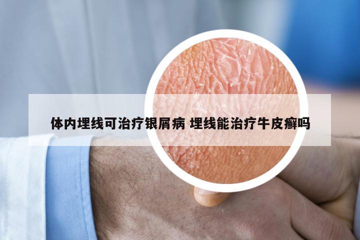 体内埋线可治疗银屑病 埋线能治疗牛皮癣吗