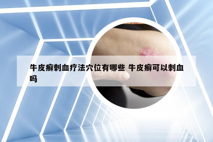 牛皮癣刺血疗法穴位有哪些 牛皮癣可以刺血吗