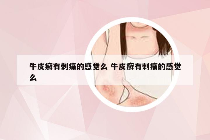 牛皮癣有刺痛的感觉么 牛皮癣有刺痛的感觉么