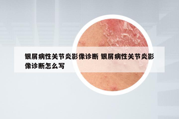 银屑病性关节炎影像诊断 银屑病性关节炎影像诊断怎么写