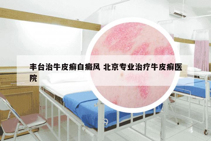 丰台治牛皮癣白癜风 北京专业治疗牛皮癣医院