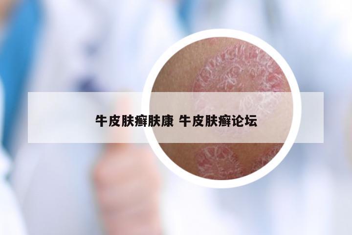 牛皮肤癣肤康 牛皮肤癣论坛