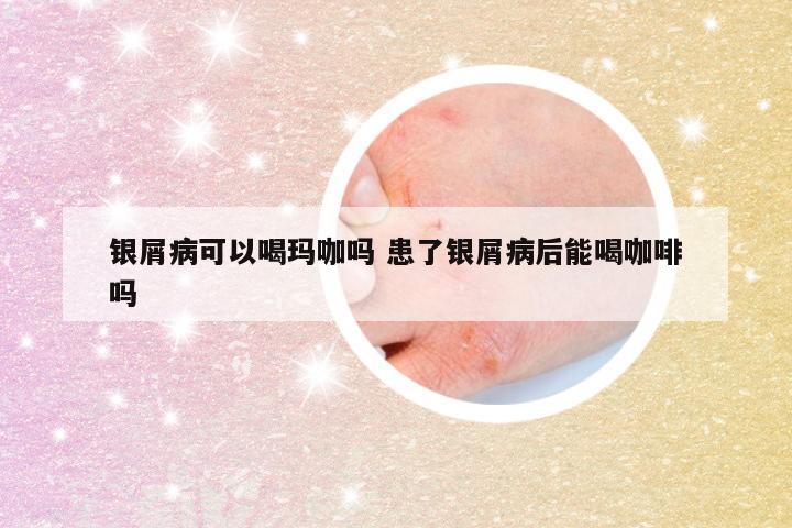 银屑病可以喝玛咖吗 患了银屑病后能喝咖啡吗