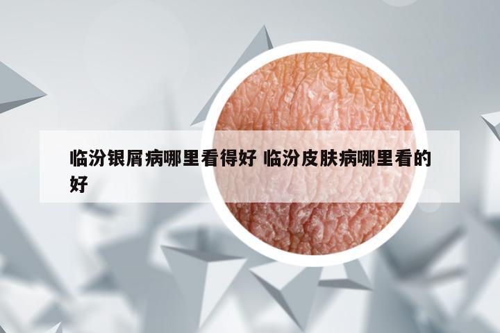 临汾银屑病哪里看得好 临汾皮肤病哪里看的好