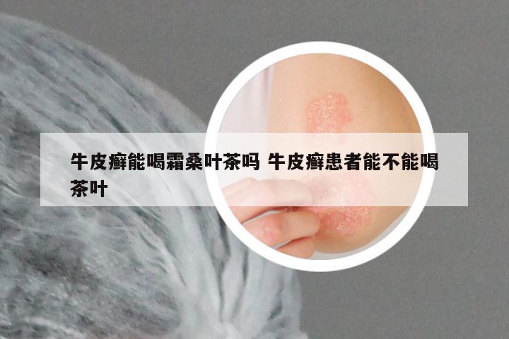 牛皮癣能喝霜桑叶茶吗 牛皮癣患者能不能喝茶叶