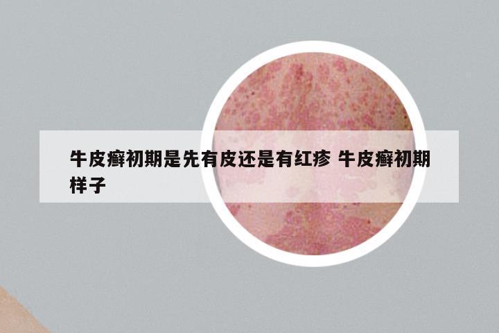牛皮癣初期是先有皮还是有红疹 牛皮癣初期样子