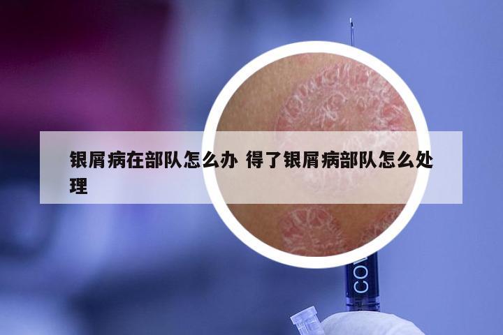 银屑病在部队怎么办 得了银屑病部队怎么处理