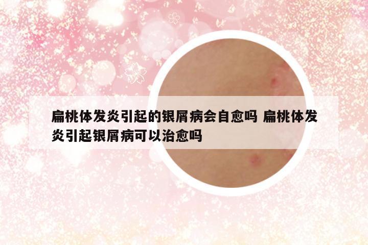 扁桃体发炎引起的银屑病会自愈吗 扁桃体发炎引起银屑病可以治愈吗