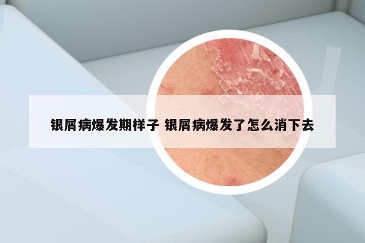 银屑病爆发期样子 银屑病爆发了怎么消下去