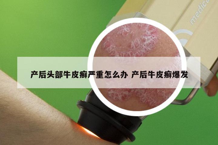 产后头部牛皮癣严重怎么办 产后牛皮癣爆发
