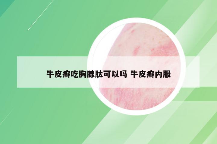 牛皮癣吃胸腺肽可以吗 牛皮癣内服