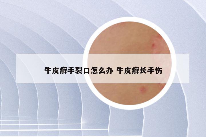 牛皮癣手裂口怎么办 牛皮癣长手伤