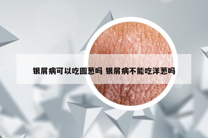 银屑病可以吃圆葱吗 银屑病不能吃洋葱吗