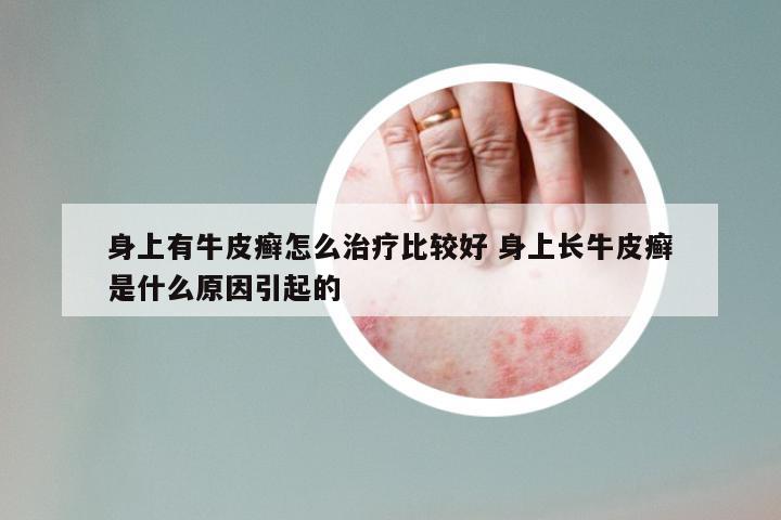身上有牛皮癣怎么治疗比较好 身上长牛皮癣是什么原因引起的