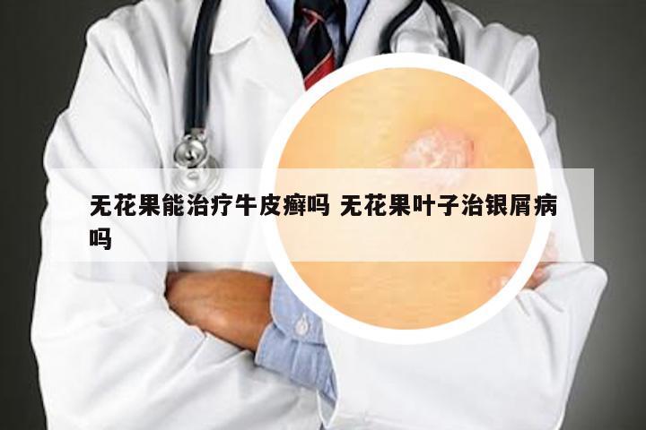 无花果能治疗牛皮癣吗 无花果叶子治银屑病吗