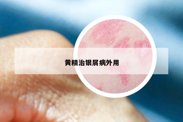 黄精治银屑病外用