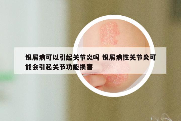 银屑病可以引起关节炎吗 银屑病性关节炎可能会引起关节功能损害