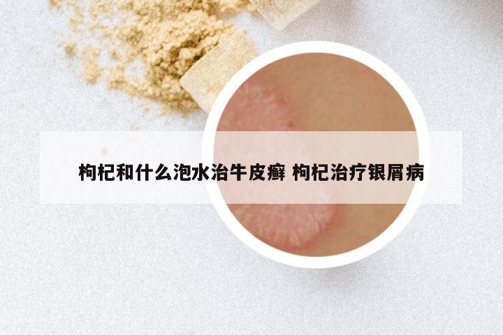 枸杞和什么泡水治牛皮癣 枸杞治疗银屑病
