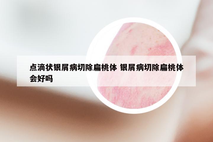 点滴状银屑病切除扁桃体 银屑病切除扁桃体会好吗