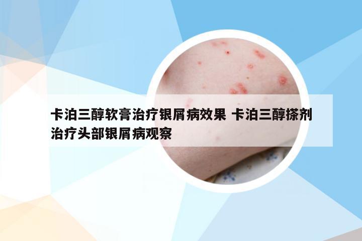 卡泊三醇软膏治疗银屑病效果 卡泊三醇搽剂治疗头部银屑病观察