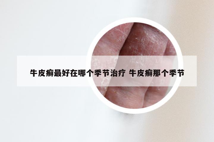 牛皮癣最好在哪个季节治疗 牛皮癣那个季节