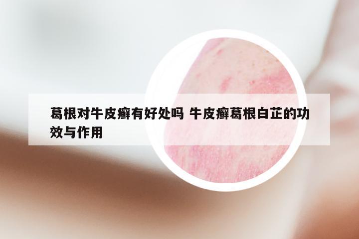 葛根对牛皮癣有好处吗 牛皮癣葛根白芷的功效与作用