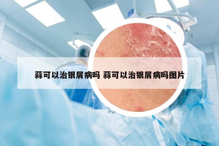 蒜可以治银屑病吗 蒜可以治银屑病吗图片