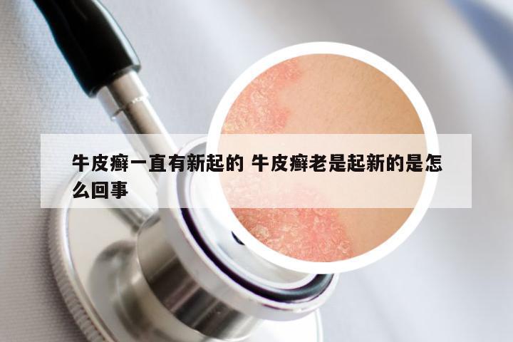 牛皮癣一直有新起的 牛皮癣老是起新的是怎么回事