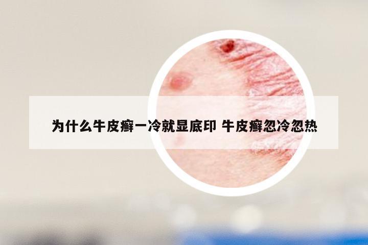 为什么牛皮癣一冷就显底印 牛皮癣忽冷忽热