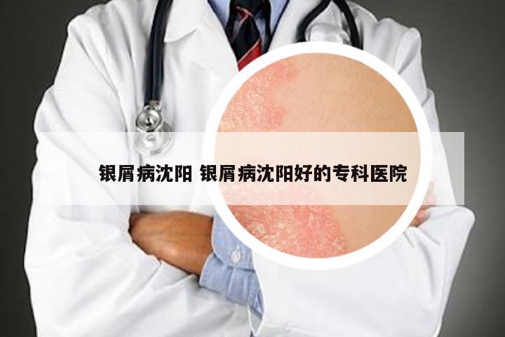 银屑病沈阳 银屑病沈阳好的专科医院