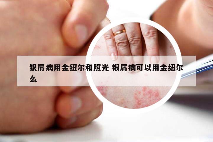 银屑病用金纽尔和照光 银屑病可以用金纽尔么