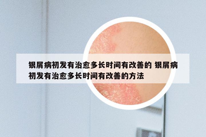 银屑病初发有治愈多长时间有改善的 银屑病初发有治愈多长时间有改善的方法