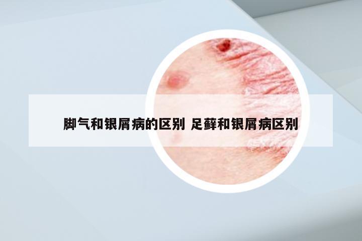 脚气和银屑病的区别 足藓和银屑病区别