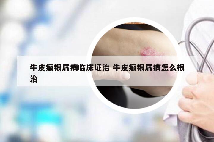 牛皮癣银屑病临床证治 牛皮癣银屑病怎么根治