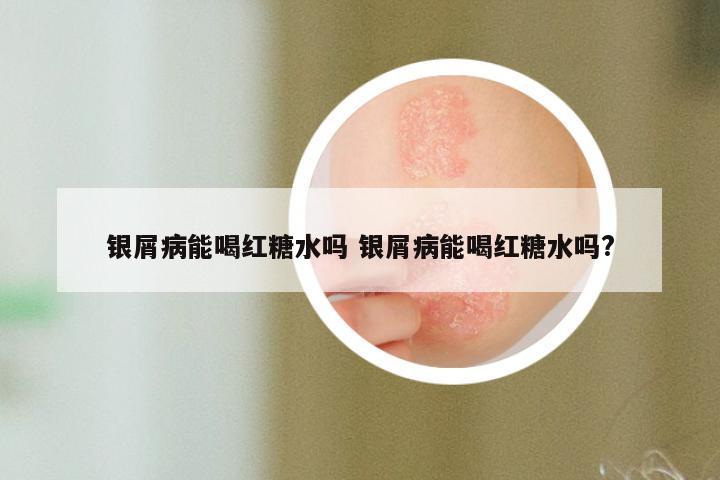 银屑病能喝红糖水吗 银屑病能喝红糖水吗?