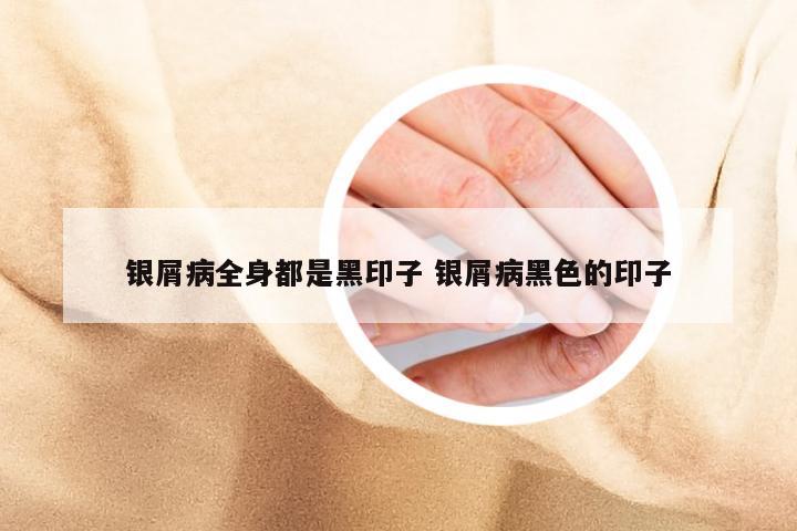 银屑病全身都是黑印子 银屑病黑色的印子