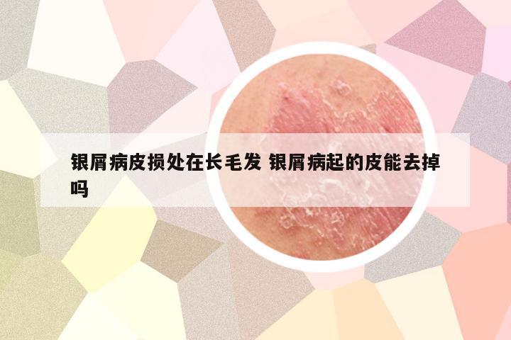 银屑病皮损处在长毛发 银屑病起的皮能去掉吗