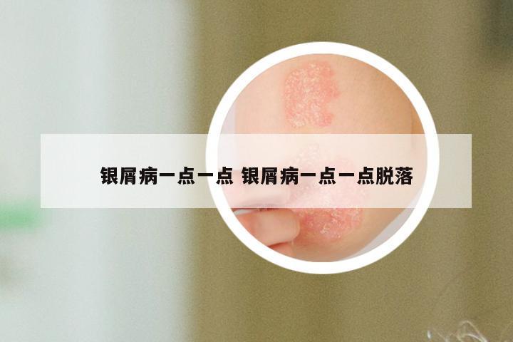 银屑病一点一点 银屑病一点一点脱落