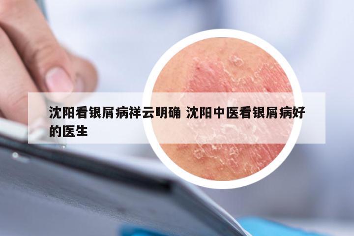 沈阳看银屑病祥云明确 沈阳中医看银屑病好的医生