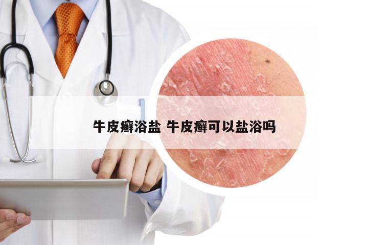 牛皮癣浴盐 牛皮癣可以盐浴吗