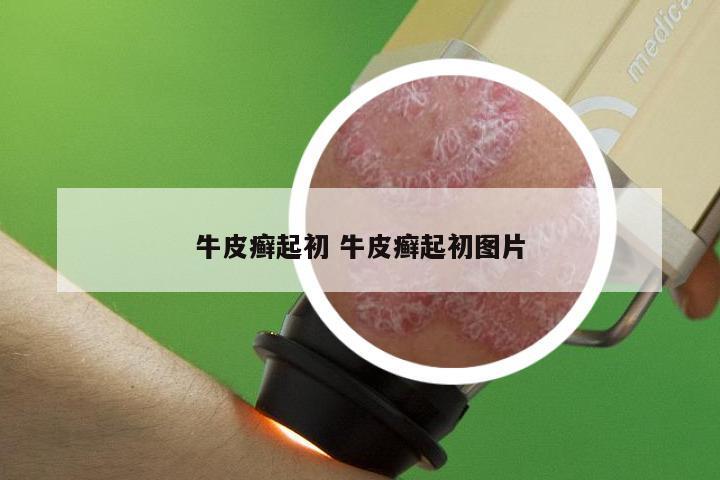 牛皮癣起初 牛皮癣起初图片