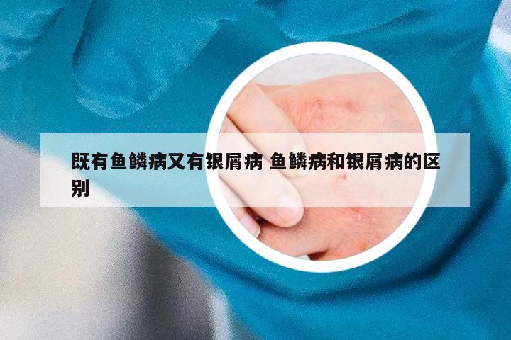 既有鱼鳞病又有银屑病 鱼鳞病和银屑病的区别