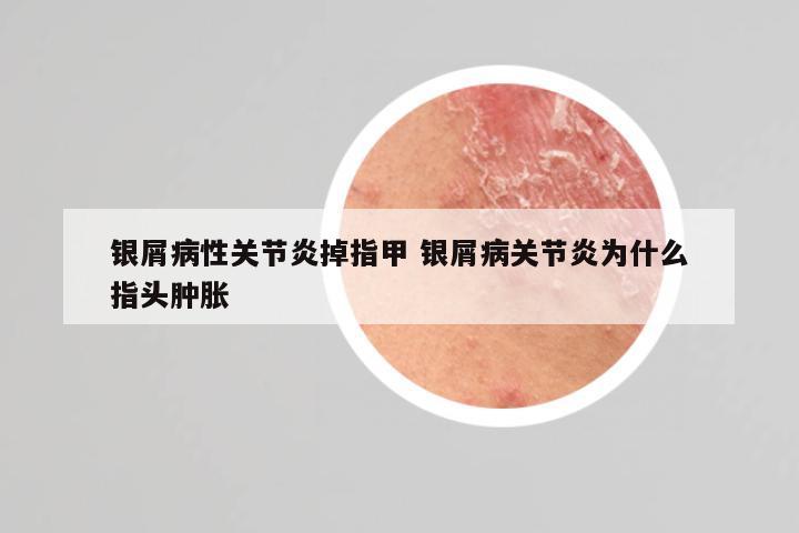 银屑病性关节炎掉指甲 银屑病关节炎为什么指头肿胀