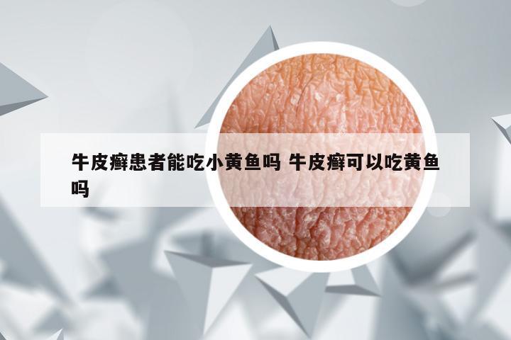 牛皮癣患者能吃小黄鱼吗 牛皮癣可以吃黄鱼吗