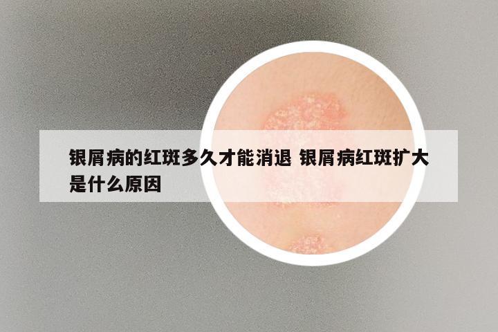 银屑病的红斑多久才能消退 银屑病红斑扩大是什么原因