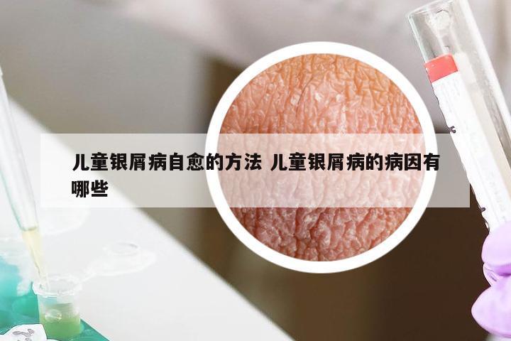 儿童银屑病自愈的方法 儿童银屑病的病因有哪些