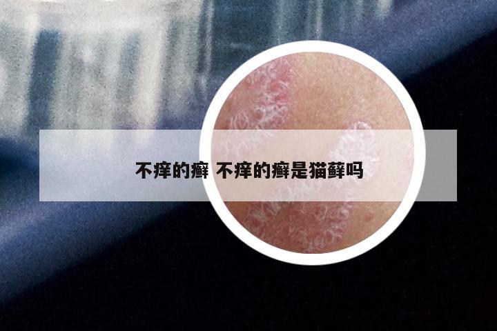 不痒的癣 不痒的癣是猫藓吗