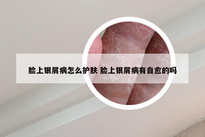 脸上银屑病怎么护肤 脸上银屑病有自愈的吗
