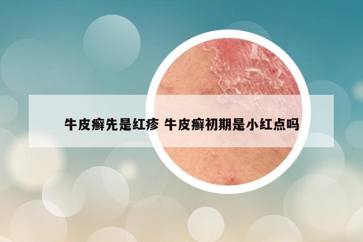 牛皮癣先是红疹 牛皮癣初期是小红点吗